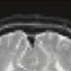 3d Scalable Lossless Compression Of Medical Images Based On Global And Local Symmetries