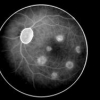 A quantification framework for post-lesion neo-vascularization in retinal angiography
