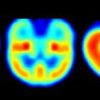Effect of the normalization template in statistical parametric mapping of PET scans