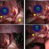 Motion Compensated SLAM for Image Guided Surgery