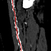 Non-Linear Model Fitting to Parameterize Diseased Blood Vessels