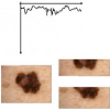 Qualitative Asymmetry Measure for Melanoma Detection