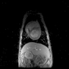 Segmenting a beating heart using polysegment and Spatial GPCA