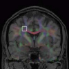 Validation and regularization in diffusion MRI tractography